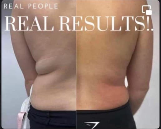 Fat freezing and cavitation before and after