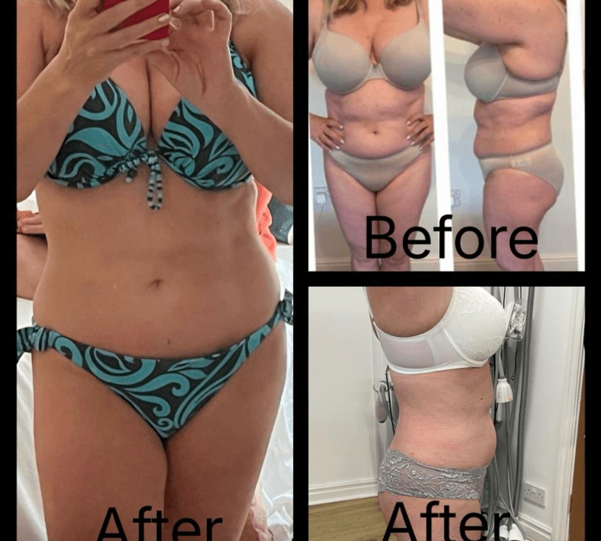 Before and after full body contouring package at HBT Aesthetics